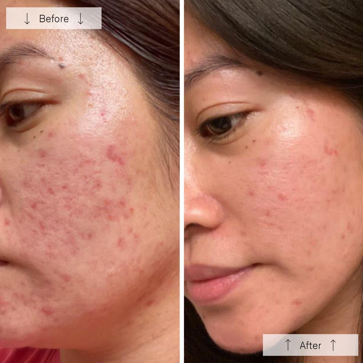Omnilux Clear - LED Mask